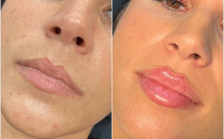 How to Address Allergic Reactions to Juvederm at the Best Aesthetic Clinics in Dubai