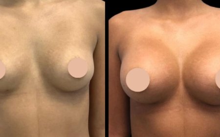 How Breast Augmentation Surgery in Dubai Compares Globally