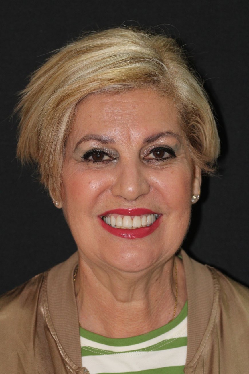 Implante Dental en Hospitalet de Llobregat Recupera tu Sonrisa