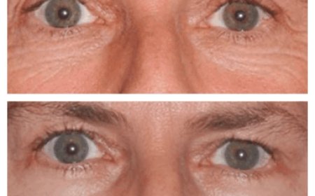 Eye Bag Removal for Young Adults: Tips from the Best Eye Bag Removal Surgeon in Dubai