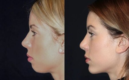 Chin Fillers in Dubai: How to Achieve Balanced Facial Features