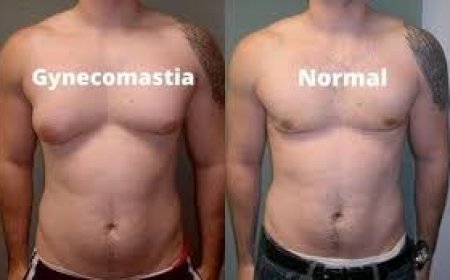 Why Male Breast Reduction in Islamabad Is Gaining Popularity