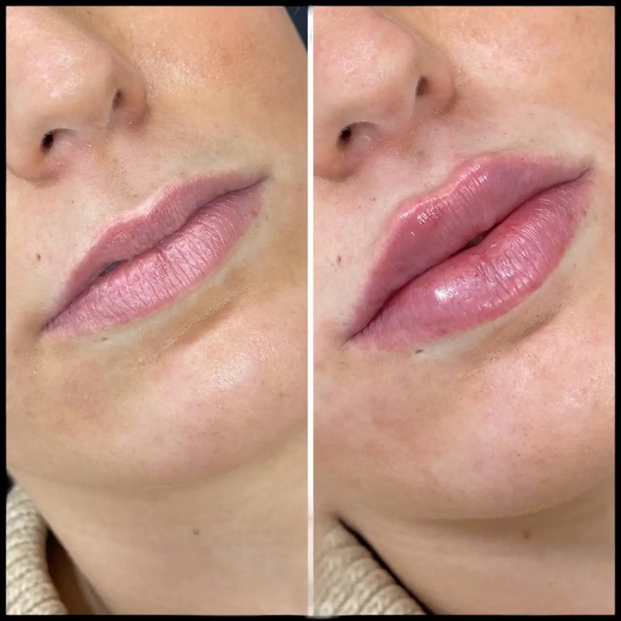 A Beginner’s Guide to Russian Lip Fillers in Dubai